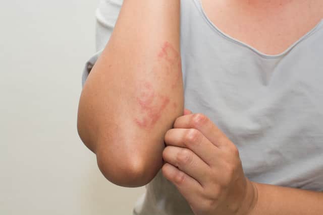 Specific lotions and creams are needed to treat scabies, though there are other treatments available to help with the itching caused by the parasite.