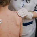 Chickenpox is a viral infection that mostly affects children, although you can get it at any age
