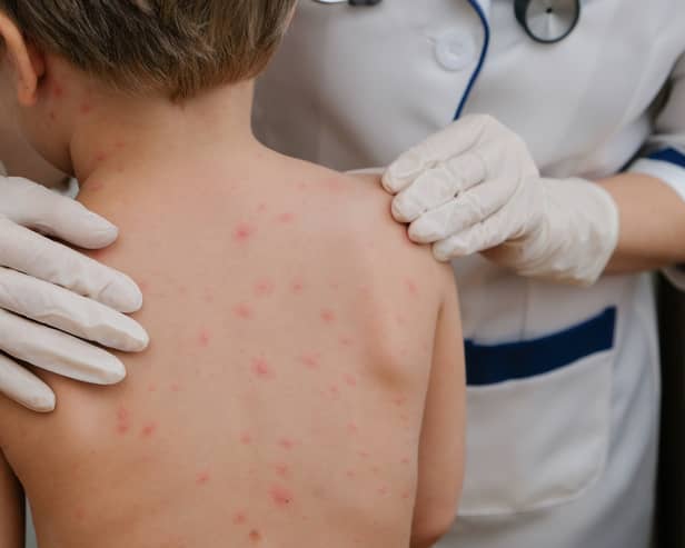 Chickenpox is a viral infection that mostly affects children, although you can get it at any age