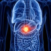 Here are signs of pancreatic cancer you can look out for 