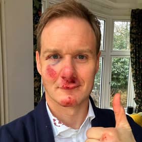 Dan Walker says he has no memory of the crash which left him bloody and bruised. Credit: Dan Walker