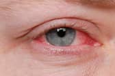 A new Covid variant, which has been found to be more infectious, is said to have an added rare symptom of conjunctivitis or pinkeye. 