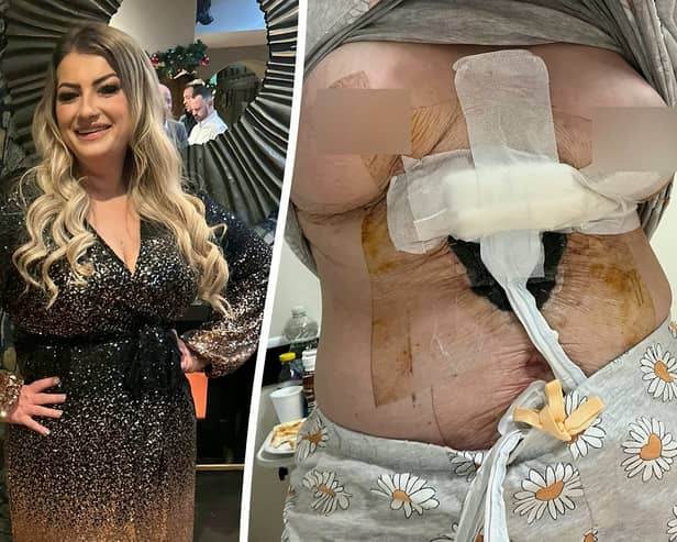 Sara Platt during happier times (L) and her right breast died and she contracted an anti-biotic resistant infection after a ’botched’ Turkish cosmetic surgery (R). (Sara Platt / SWNS)