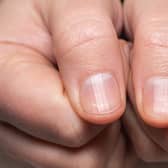 'Beau's lines' are transverse indents in the nail (Photo: Shutterstock)