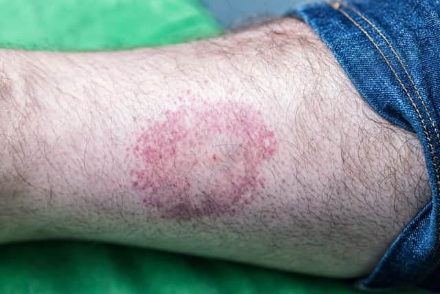 When dealing with tick bites there are several symptoms or ‘complications’ to look out for. The most famous is the emergence of a circular rash which may indicate Lyme disease.
