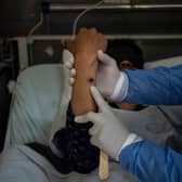 A doctor checks on a patient with sores caused by a mpox infection. (Photo: ERNESTO BENAVIDES/AFP via Getty Images)