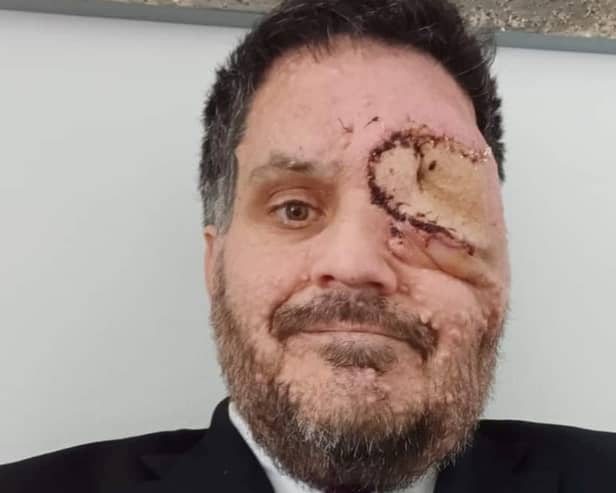 Man with facial disfigurement told to leave restaurant for "scaring customers"