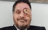 Man with facial disfigurement told to leave restaurant for "scaring customers"