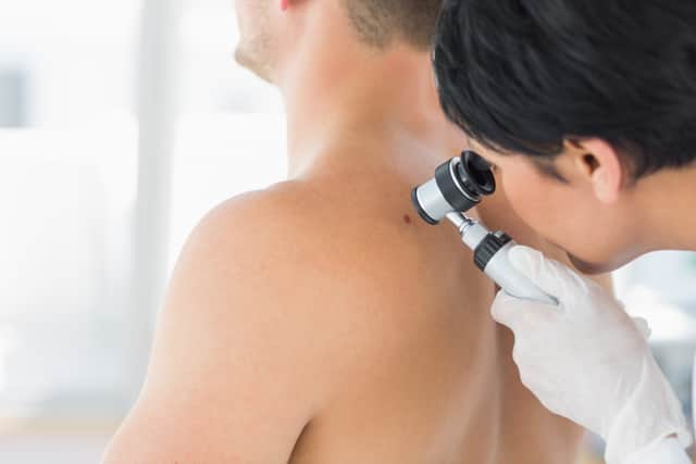 Mole being examined
