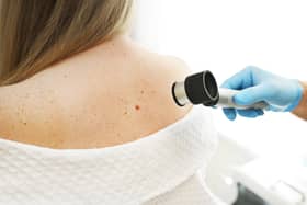 Mole check