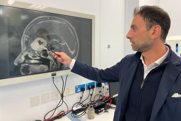 Anastasios Giamouriadis, a consultant neurosurgeon at NHS Grampian, has adapted an existing technique of keyhole surgery to remove tumours, which leaves considerably less scarring than regular craniotomies