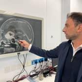 Anastasios Giamouriadis, a consultant neurosurgeon at NHS Grampian, has adapted an existing technique of keyhole surgery to remove tumours, which leaves considerably less scarring than regular craniotomies