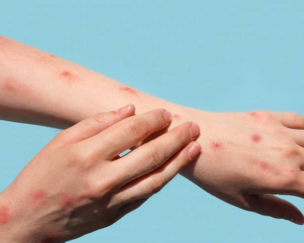 A fifth UK case of mpox Clade Ib has been found in Leeds