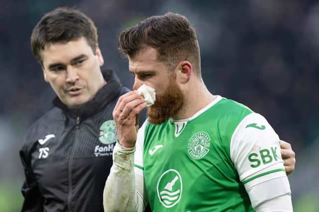 Hibs winger Nicky Cadden will wear a protective face mask against Ross County.