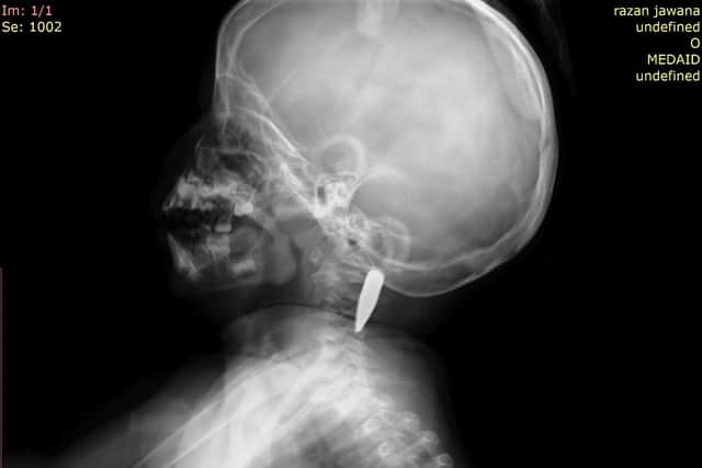 A CT scan of Razan showing the bullet lodged in her neck