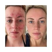 Customers share amazing before and after results of skincare brand that took the world by storm - Abigail's results 47 Skin 