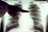 Catching and treating cancer quickly can save lives