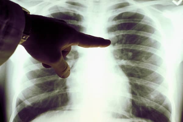 Catching and treating cancer quickly can save lives