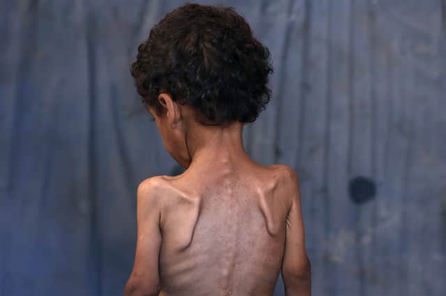 Yazan, a malnourished two-year-old Palestinian boy, pictured in the Al-Shati refugee camp, west of Gaza City, earlier this month (Picture: Omar Al-Qattaa)