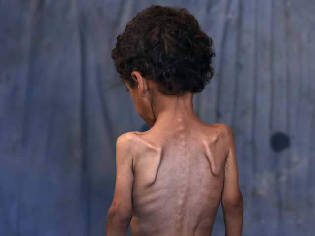 Yazan, a malnourished two-year-old Palestinian boy, pictured in the Al-Shati refugee camp, west of Gaza City, earlier this month (Picture: Omar Al-Qattaa)