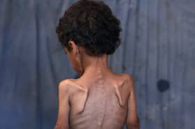 Yazan, a malnourished two-year-old Palestinian boy, pictured in the Al-Shati refugee camp, west of Gaza City, earlier this month (Picture: Omar Al-Qattaa)