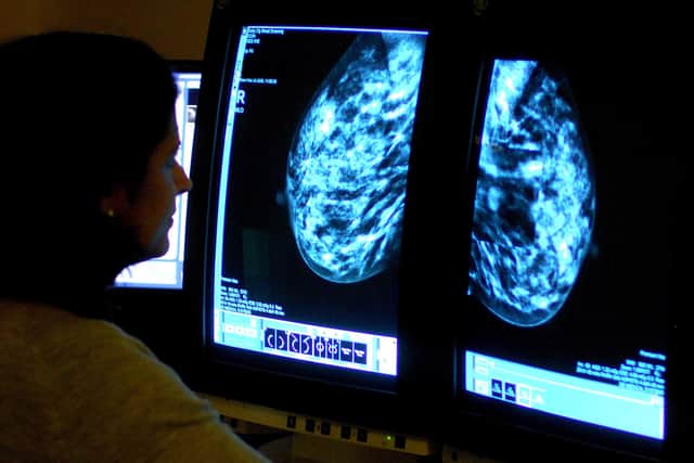 A consultant analysing a mammogram of a woman's breast in order to check for breast cancer.