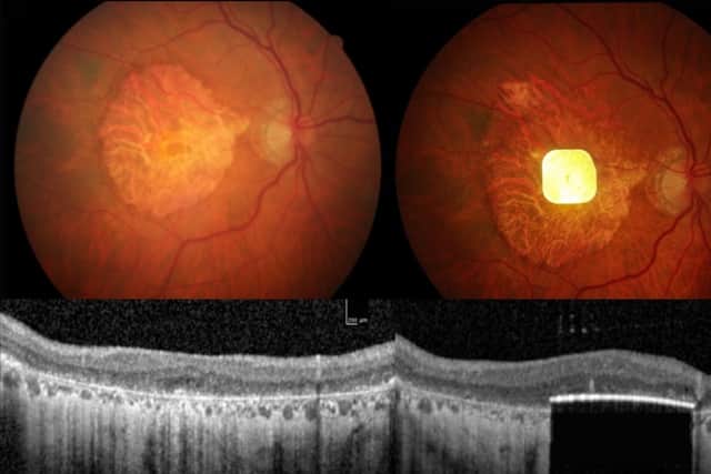 The new electronic eye implant that has enabled people who have lost their sight to geographic atrophy to read and write again. Picture: Science Corporation/PA Wire