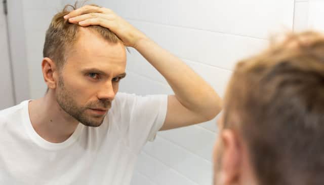 Many Scots travel to Turkey for hair transplants.