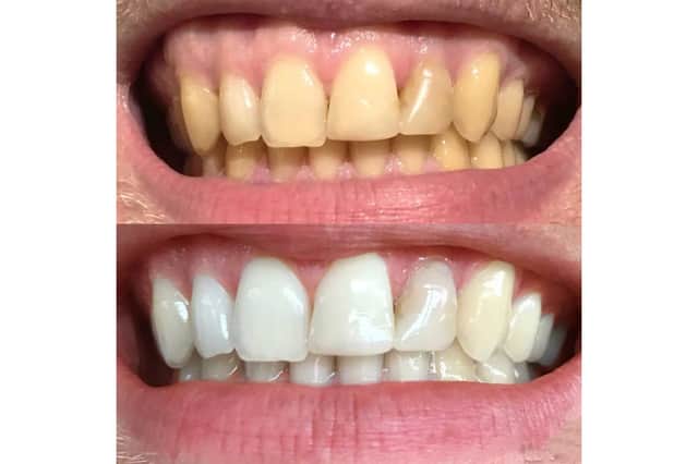 SmilePro teeth whitening kit