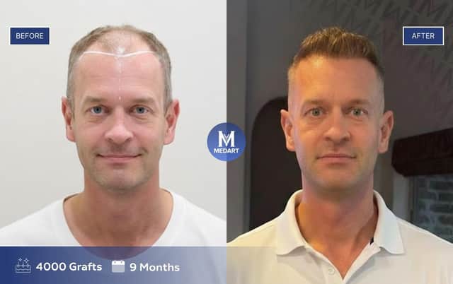 Image for illustration purposes only. Remarkable before and after result showing restored hair density in MedArt patient