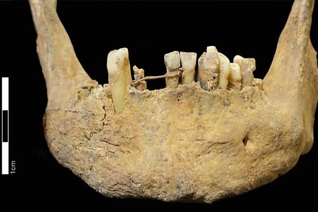The gold ligature was identified following excavation work. Picture: Jenna Dittmar/British Dental Journal