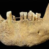 The gold ligature was identified following excavation work. Picture: Jenna Dittmar/British Dental Journal