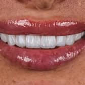 The Hollywood Smile treatment modifies the appearance of a person's teeth, the changes can be the color, shape, or even the alignment.