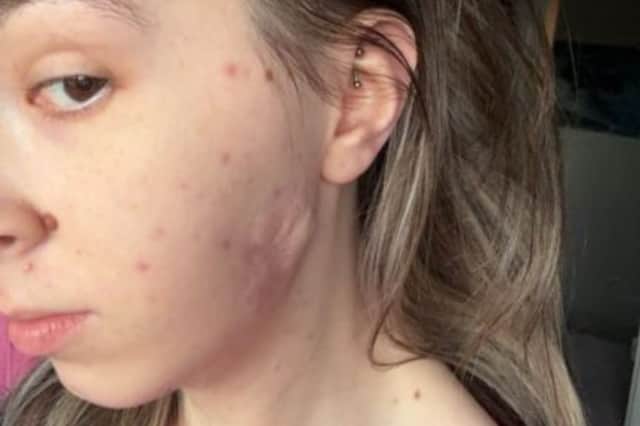 Leyla underwent surgery to remove the sarcoma, which left her physical and emotional scars.