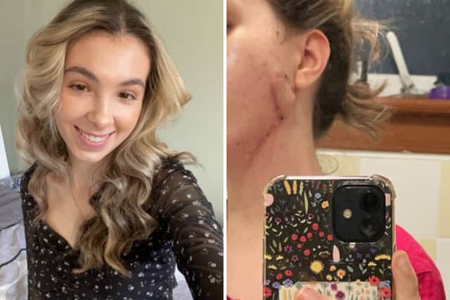 Leyla Cort, 23, was diagnosed with spindle cell sarcoma in July 2023 after years of her pain being dismissed by doctors.