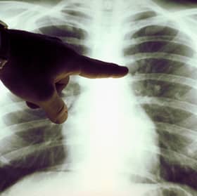 Cancer mortality rates are substantially higher in deprived areas