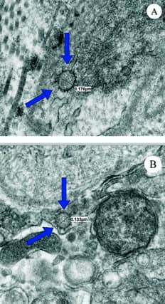 Ultrastructure features of penile tissue from live seroconverted COVID-19 patients. (A) Coronavirus-like spiked viral particles (arrows) visualized via TEM in the peri-vascular erectile tissue of a live patient who had previously contracted the COVID-19 virus and subsequently seroconverted. Particle diameter measurement indicated on image. (B) Coronavirus-like spiked viral particles (arrows) visualized via TEM in the peri-vascular erectile tissue of a live patient who had previously contracted the Covid-19 virus and subsequently seroconverted. Particle diameter measurement indicated on image. (Photo: University of Miami / SWNS).