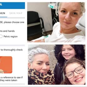 Primary school teacher Adele Hughes was diagnosed with melanoma a month before her 40th birthday and then successfully treated for the disease, and has praised a new smartphone app in development