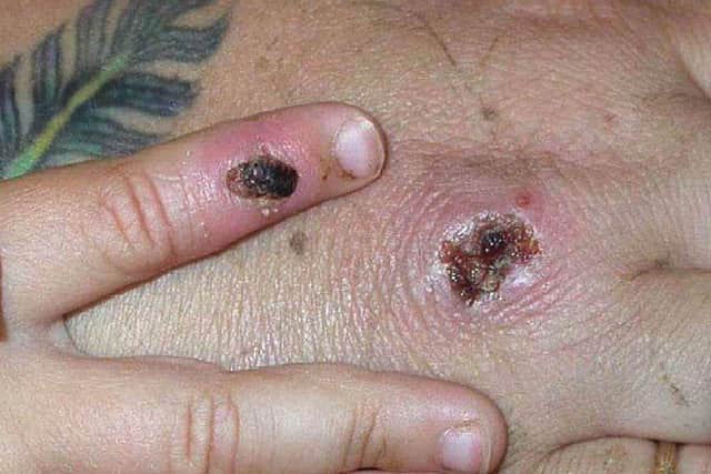 Monkeypox causes a rash which goes through different stages before finally forming a scab