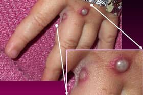 Monkeypox causes boils and sores to develop