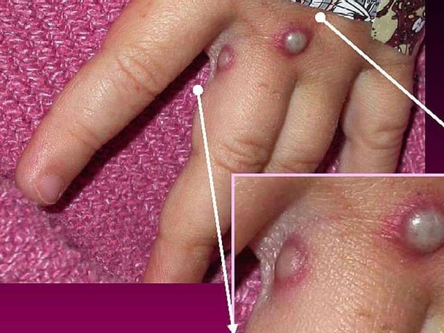 Monkeypox causes boils and sores to develop