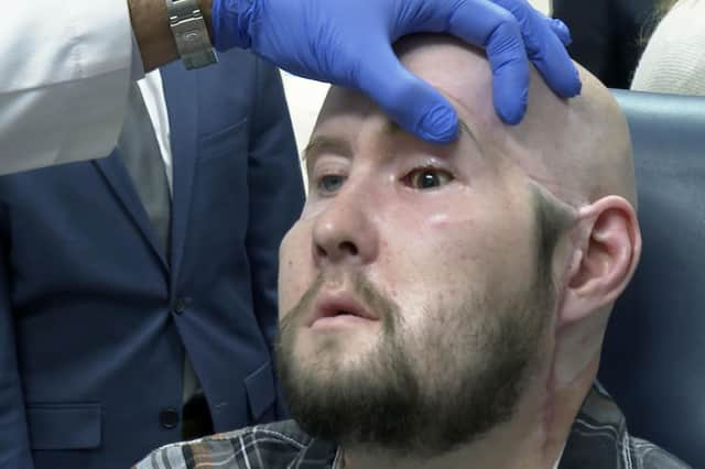 Dr. Eduardo Rodriguez, NYU Langone Health's chair of plastic surgery, examines Aaron James in New York (AP Photo/Joseph. B. Frederick)