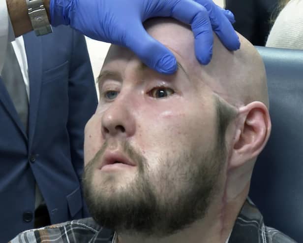 Dr. Eduardo Rodriguez, NYU Langone Health's chair of plastic surgery, examines Aaron James in New York (AP Photo/Joseph. B. Frederick)