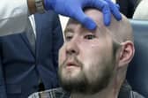 Dr. Eduardo Rodriguez, NYU Langone Health's chair of plastic surgery, examines Aaron James in New York (AP Photo/Joseph. B. Frederick)