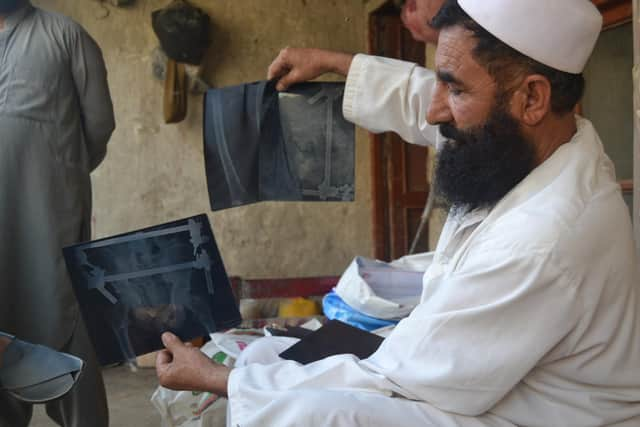 Mostaqim with x-ray images of the injuries he sustained in a suicide bomb attack.