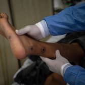 A doctor checks on a patient with sores caused by an mpox infection in 2022. (Photo by ERNESTO BENAVIDES/AFP via Getty Images)