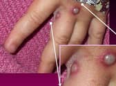 Monkeypox fatalities have been lower than feared