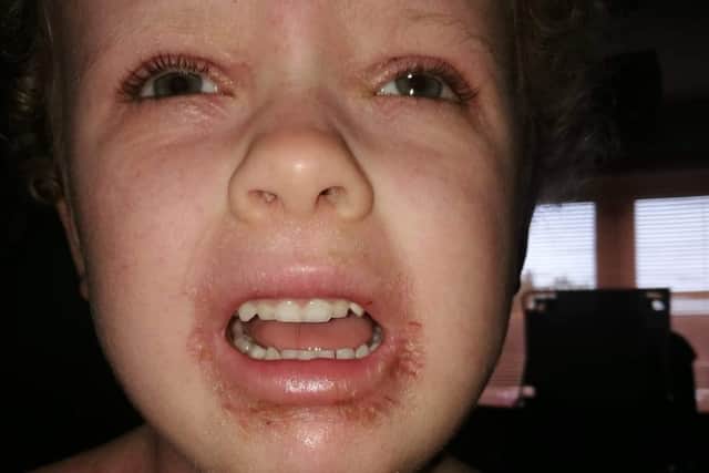 Olivia during a flare-up of her eczema.
