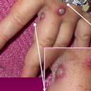 In this Centers for Disease Control and Prevention handout graphic, from 2003, symptoms of one of the first known cases of the monkeypox virus are shown on a patient's hand Pic: CDC/Getty Images