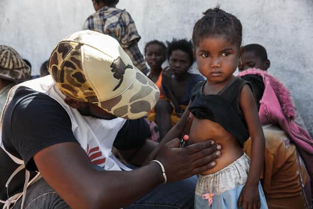 A nurse from a Doctors Without Borders (MSF) mobile clinic in Befeno, Commune Marovato, Madagascar, inspects a little girl as he selects the most urgent cases for treatment amid widespread malnutrition and drought (Picture: Rijasolo/AFP via Getty Images)